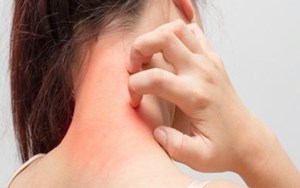 CK 005 Gói xét nghiệm chẩn đoán dị ứng